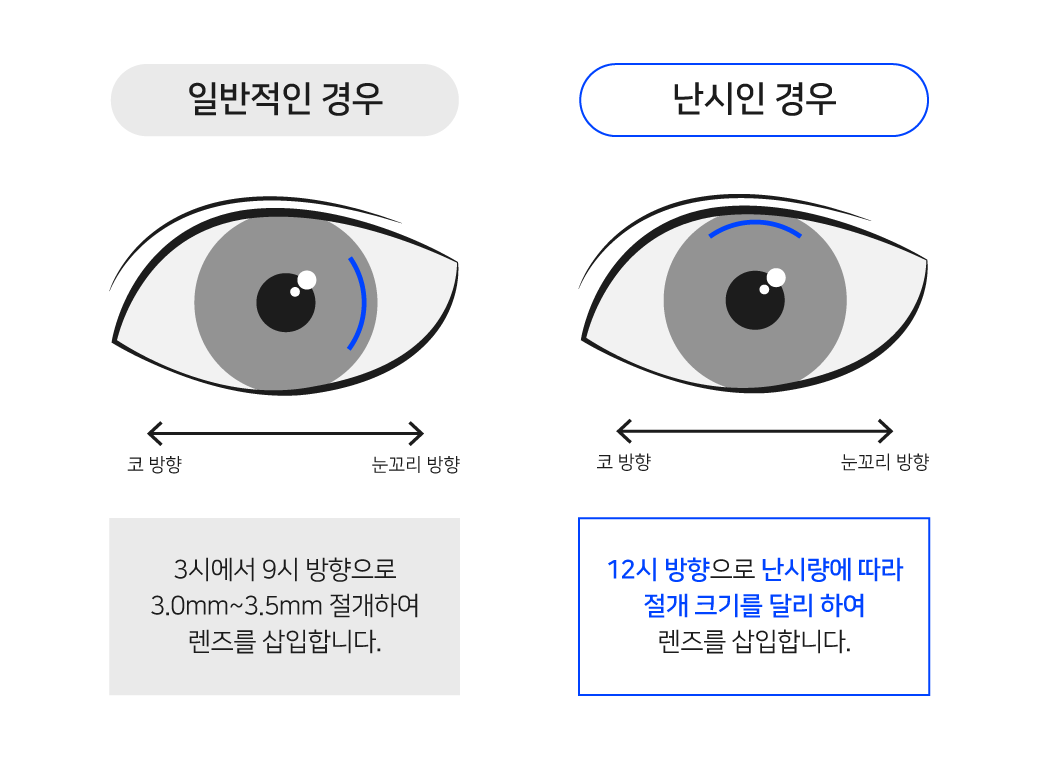 난시-절개.png